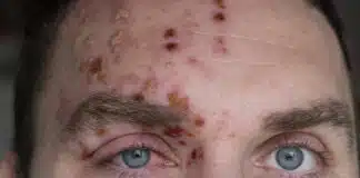 Herpes Zoster: presto anche in Italia il nuovo vaccino