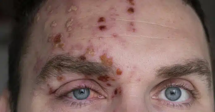 Herpes Zoster: presto anche in Italia il nuovo vaccino