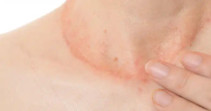 dermatite atopica tralokinumab