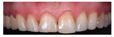 Il nuovo trend in odontoiatria: lo smile makeover con le faccette dentali