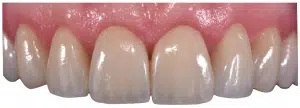Il nuovo trend in odontoiatria: lo smile makeover con le faccette dentali