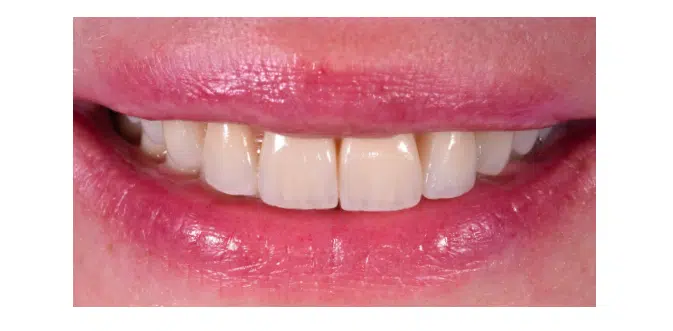 Il nuovo trend in odontoiatria: lo smile makeover con le faccette dentali