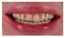 Il nuovo trend in odontoiatria: lo smile makeover con le faccette dentali