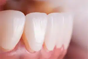 faccette dentali