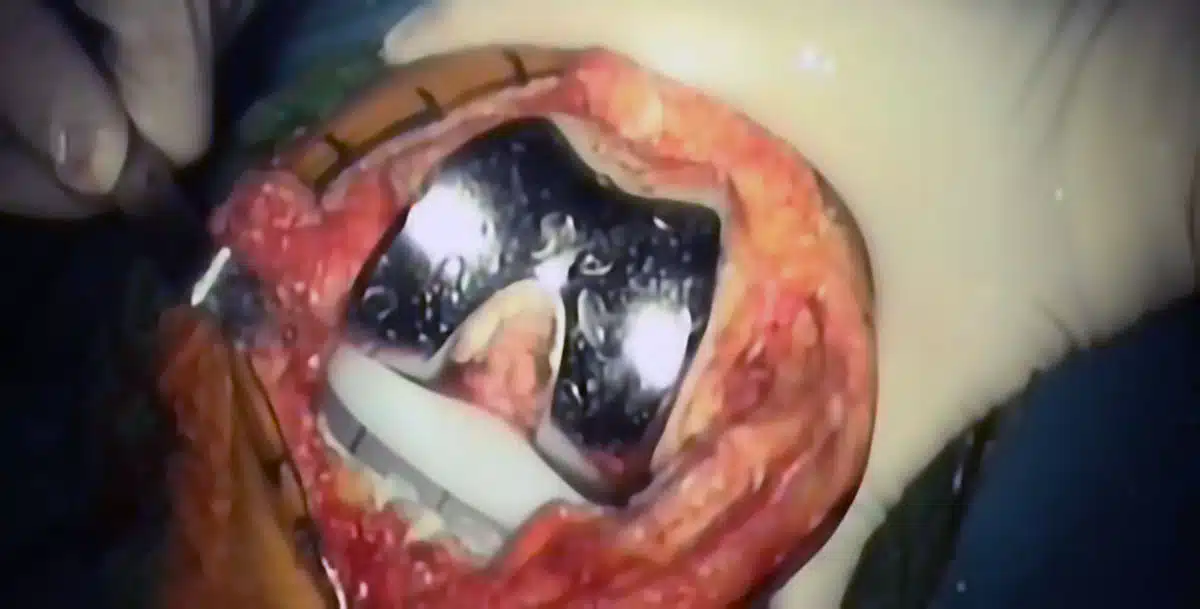 protesi ginocchio intervento claudio zara