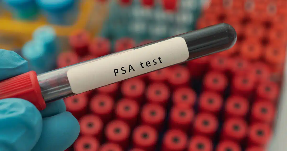 PSA tumore prostata chirurgia robotica