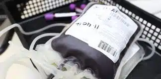 Meno trasfusioni di sangue nei pazienti supportati con ossigenazione extracorporea a membrana