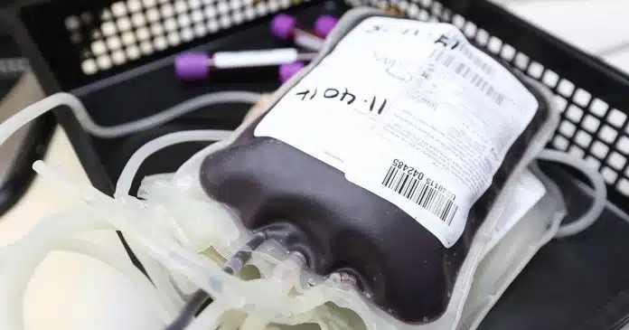Meno trasfusioni di sangue nei pazienti supportati con ossigenazione extracorporea a membrana