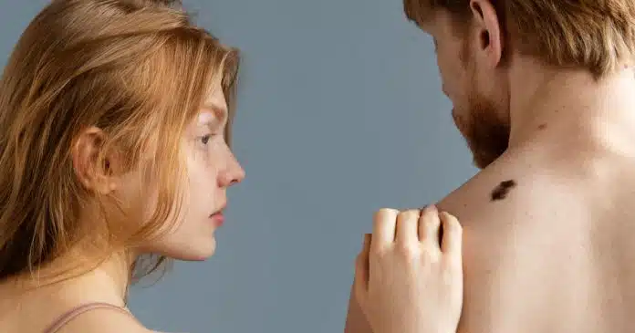 Melanoma: primo tumore killer tra i 20 e i 30 anni. Presentato cortometraggio